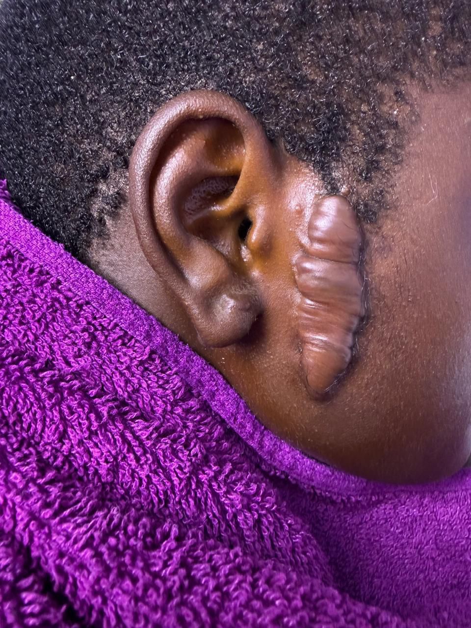 Facial treatment
